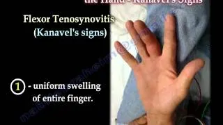 Flexor Tenosynovitis Of The Hand Kanavel's Signs - Everything You Need To Know - Dr. Nabil Ebraheim