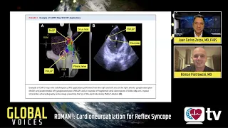 Global EP: ROMAN I - Cardioneuroablation for Reflex Syncope