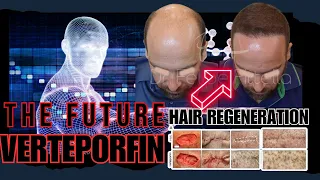 Dr. Felipe Pittella Will Start A Verteporfin Trial * Possible Hair Loss Cure