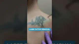 Get Your Tattoo Removed In Just ₹99 | Laser Tattoo Removal #shorts #tattoo #tattooremove