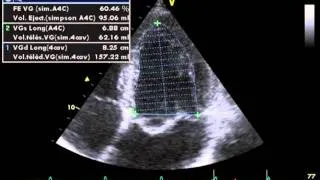 ACCURATE MEASUREMENT OF LVEF  (left ventricular ejection fraction) by biplane simpson's method