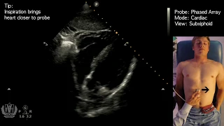 Subxiphoid View - Transthoracic Ultrasound (Echocardiography)