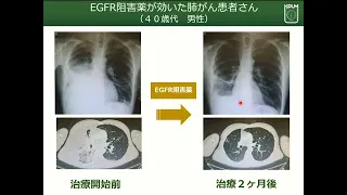 ⑤講演(4) 肺がんの薬物療法：山田 忠明（京都府立医科大学病院 呼吸器内科）