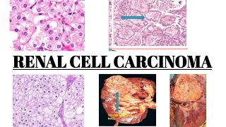 RENAL CELL CARCINOMA || IMAGES || MCQs || Wilm's Tumour