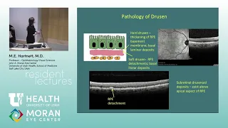 Age Related Macular Degeneration - Chapters 4, 5, 6, 12