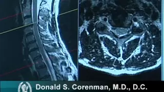 How to Read a MRI of Cervical Nerve Compression | Neck Pain | Colorado Spine Surgeon