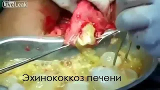 Эхинококкоз печени