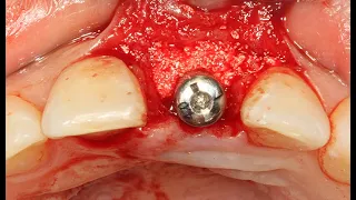 Immediate implant placement using Dentium regeneration material_Prof. Jung-Chul Park