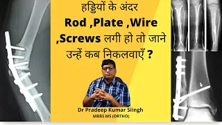 हड्डियों के अंदर Rod ,Plate ,Wire ,Screws लगी हो तो जाने उन्हें कब निकलवाएँ ?/Dr Pradeep Kumar singh