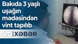 Bakıda 3 yaşlı uşağın mədəsindən vint tapılıb – ARB Xəbər