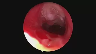 Subglottic stenosis - from injury to repair