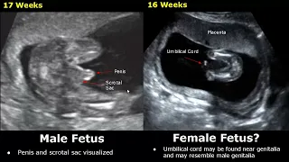 Fetal Gender Determination On Ultrasound | Determining The Sex Of A Baby On USG (Boy/Girl)