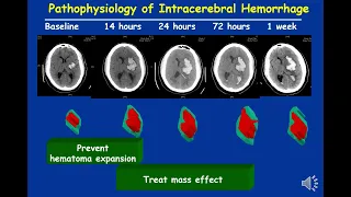 Evidence based management of intracerebral hemorrhage- An update