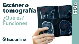 Escáner o tomografía - ¿Qué es y cómo funciona?