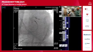 Prague Rhythm 2021, DAY 1, SESSION 3 - Live cases (Ventricular arrhythmias)