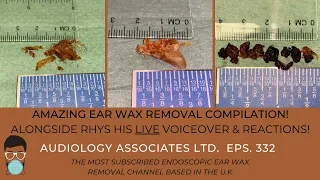 EAR WAX REMOVAL COMPILATION VIDEO - EP 332