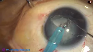 Challenging surgery- Cataract with 3 cl hours of zonular tear: done by nondominant hand- P Mohanta
