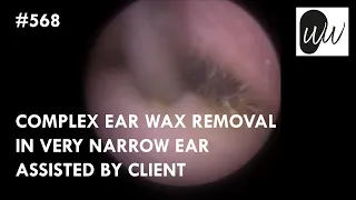 568 - Complex Ear Wax Removal in Very Narrow Ear Assisted by Client