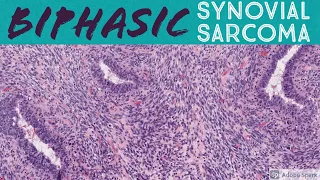 Biphasic Synovial Sarcoma: 5-Minute Pathology Pearls