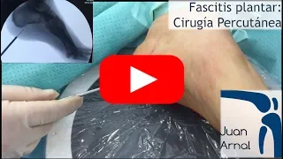 Fascitis Plantar: Cirugia Minimamente Invasiva