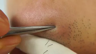 Hair removal asmr pull out with Tweezers  Satisfying pull out beard multiple No cut  22min 202401a