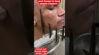 Leech therapy for face benefits? 8 sepA12 #leechtherapy#leech#kzhijama#pimples#acne#scar#skin#shorts