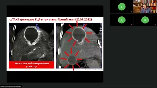Рак печени (вебинар 10 ноября 2022)