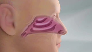 Spirox LATERA Nasal Implant - animation