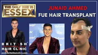 New Year, New Hairline. TOWIES Junaid Ahmed hair transplant at The British Hair Clinic