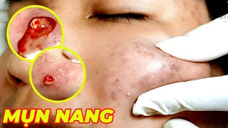 Điều trị mụn bọc, mụn nang hiệu quả tại TPHCM | Hiền Vân Spa | Cyst Acne Treatment | 697