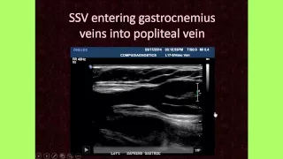 The Importance of Venous Anatomy for the Reflux Ultrasound Examination
