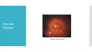 Management of Acute Vision Loss in ED