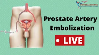 Live Prostatic Artery Embolization (PAE) Procedure Video for Enlarged Prostate Explained