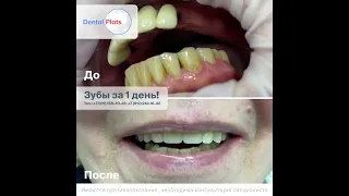 Зубы за 1 день! Протезирование на имплантатах  All on 4