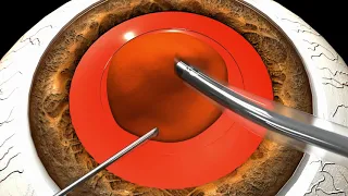 RAPID technique for en masse soft cataract phacoemulsification – ID 197359