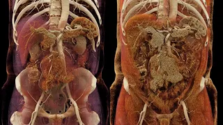 CT of the Small Bowel: Tumors Part 3