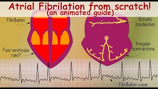 Atrial Fibrillation from scratch (a beginners guide).