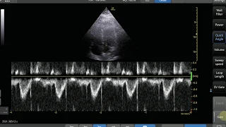 Pulse Wave Doppler Step by Step - LVOT VTI Example