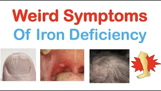 Weird Symptoms of Iron Deficiency | Nails, Tongue, Skin, Hair & Others