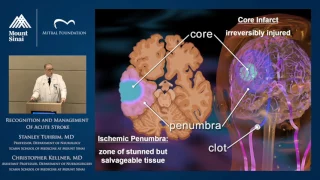 Recognition and Management of Acute Stroke