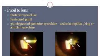 Ophthalmology - Uvea Class3: Sequelae and complications of uveitis Part1