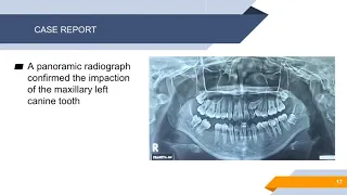 Surgical Removal Of Maxillary Impacted Canine: Labial And Palatal Approach