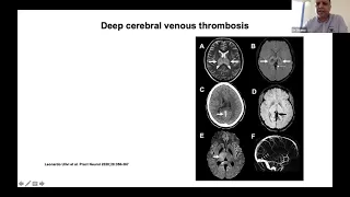 Management of cerebral venous thrombosis CVT