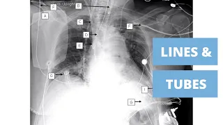 Beginners Guide to Lines and Tubes - How to Read a Chest Xray
