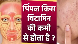 Pimple Kis Vitamin ki kami se hota hai | पिंपल किस विटामिन की कमी से होता है | Boldsky*Health