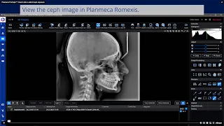 Planmeca ProCeph™: How to take a lateral ceph exposure