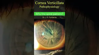Cornea Verticillata. Why the spiral pattern?.