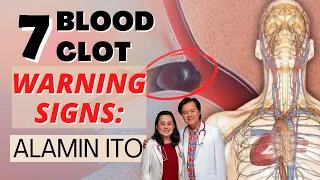 7 Blood Clot Warning Signs: Alamin Ito - By Doc Willie Ong (Internist and Cardiologist)