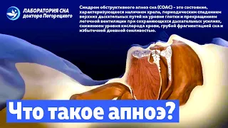 Что такое апноэ сна? Синдром обструктивного апноэ во сне (СОАС)