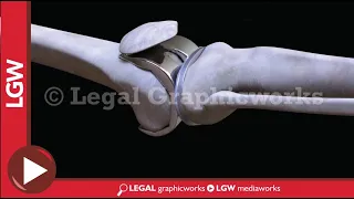 Knee Replacement Surgery Failure 3D Animation